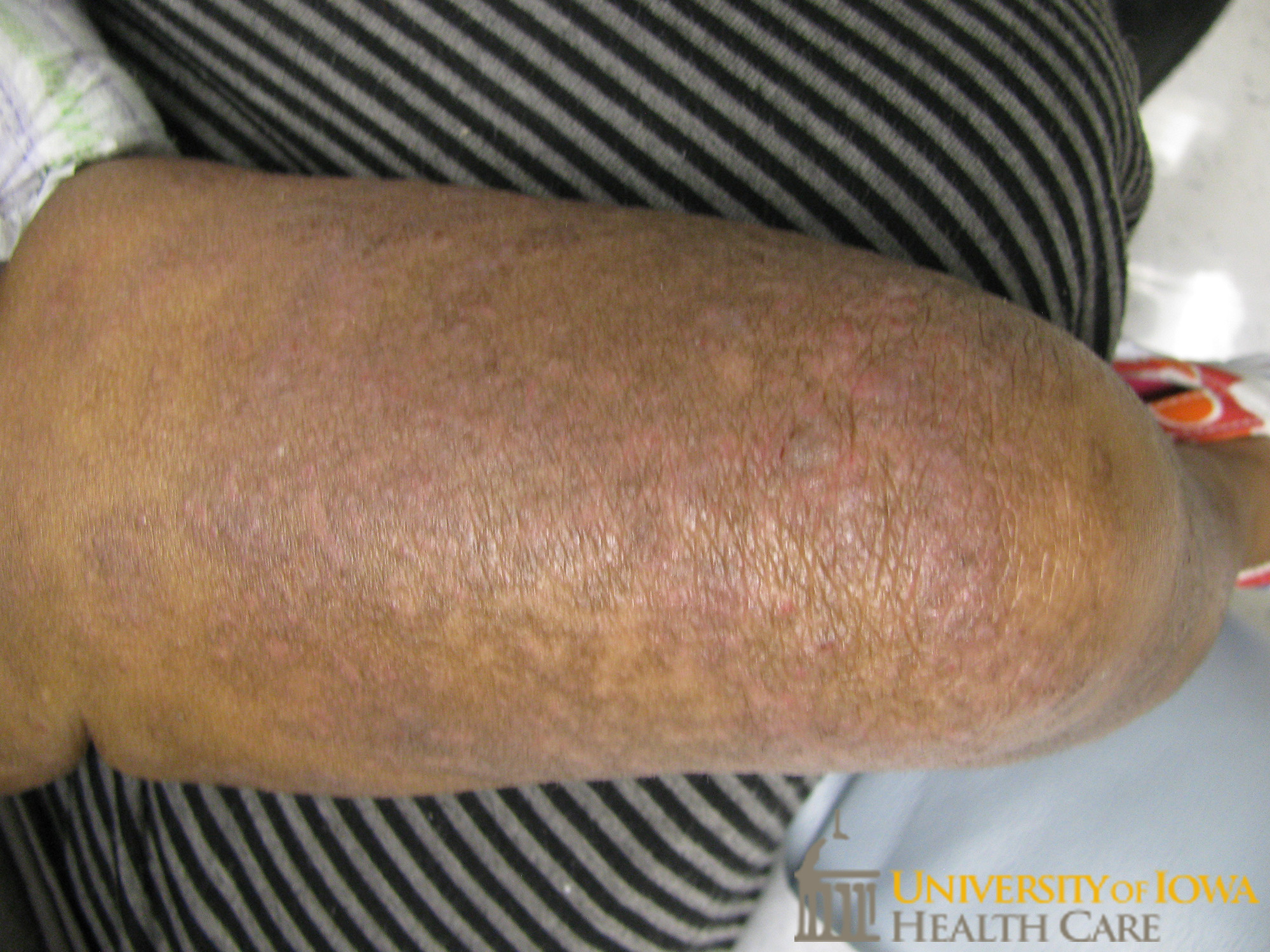 Hyperpigmented to erythematous lichenified scaly plaques on the lower legs. (click images for higher resolution).